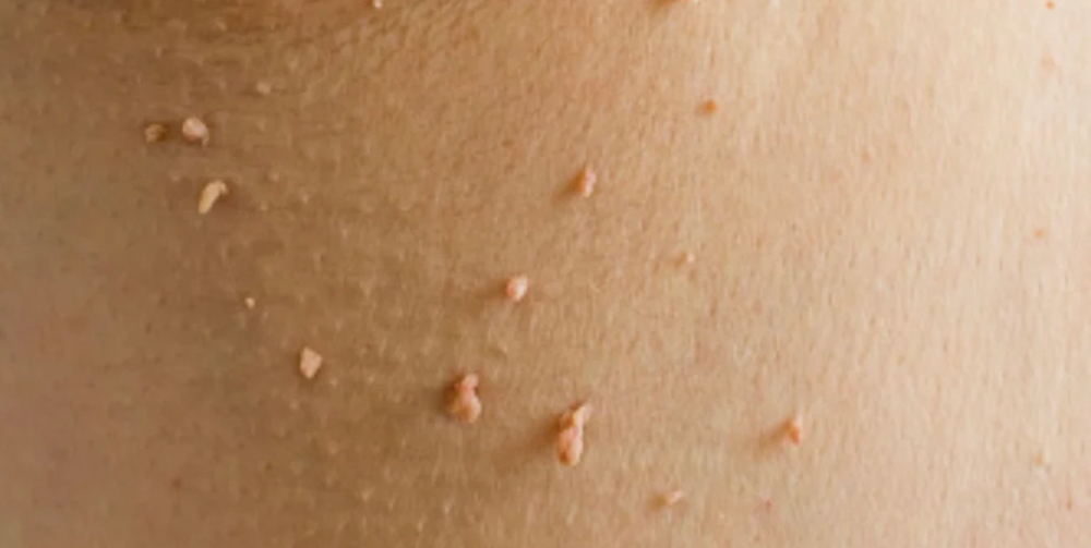 Skin Tags