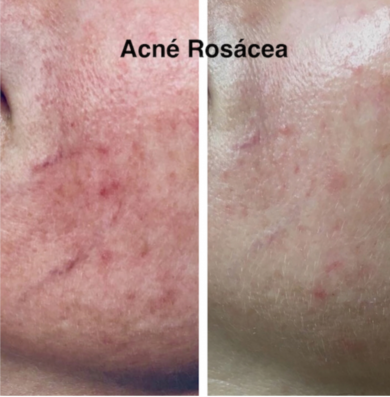 Acne & Rosacea Treatment