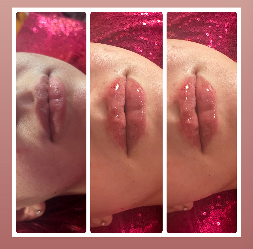 Lip Filler 2ML🫦🫦🩷 at Barbie Aesthetics 💋 in Springfield, MA
