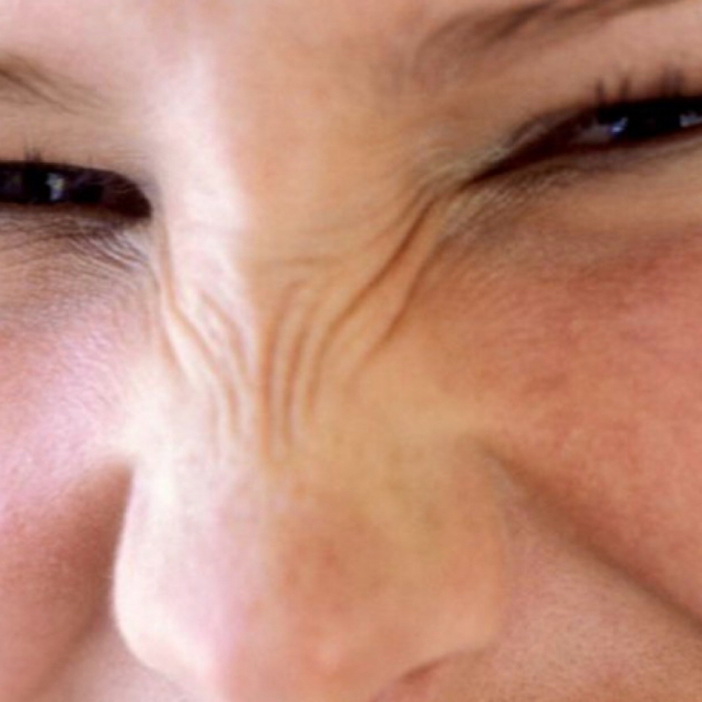 Bunny Line Injection at Precision Aesthetics LLC in Harrodsburg, KY