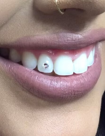 💎 Single Tooth Gem at Iconic Glo Aesthetics in Loves Park, IL