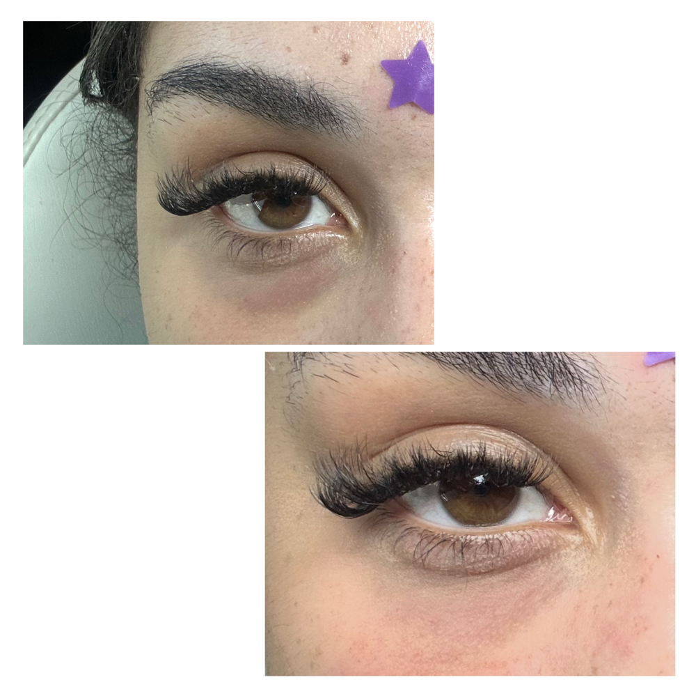 Under Eye Filler