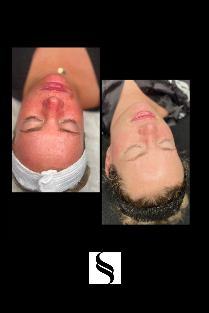 Barrier Repair and Redness Control