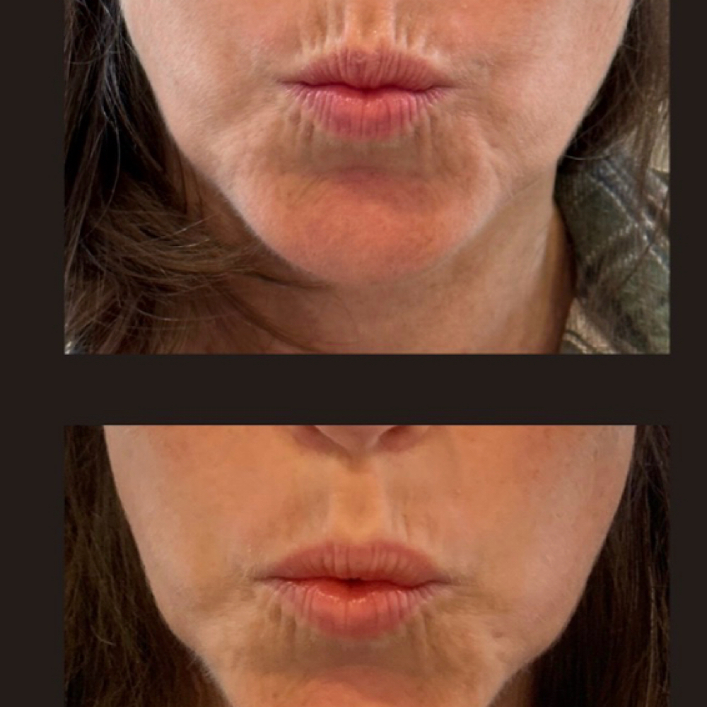 Botox-Smoker’s Lines, Upper & Lower at Groomsology by Amanda Nicole in Mt Orab, OH