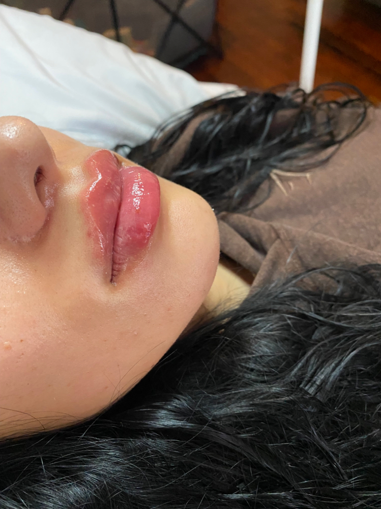 1ml Returning Client ( Microneedle)