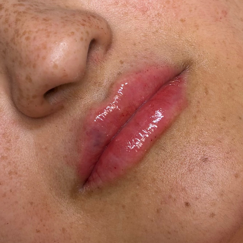 Micro-needle Lip Filler at Omni Beauty Bar in Houston, TX