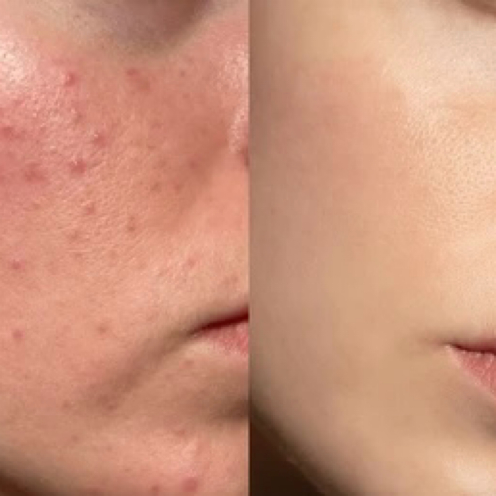 Acne at Glow by JLynn in Chesterfield, MI