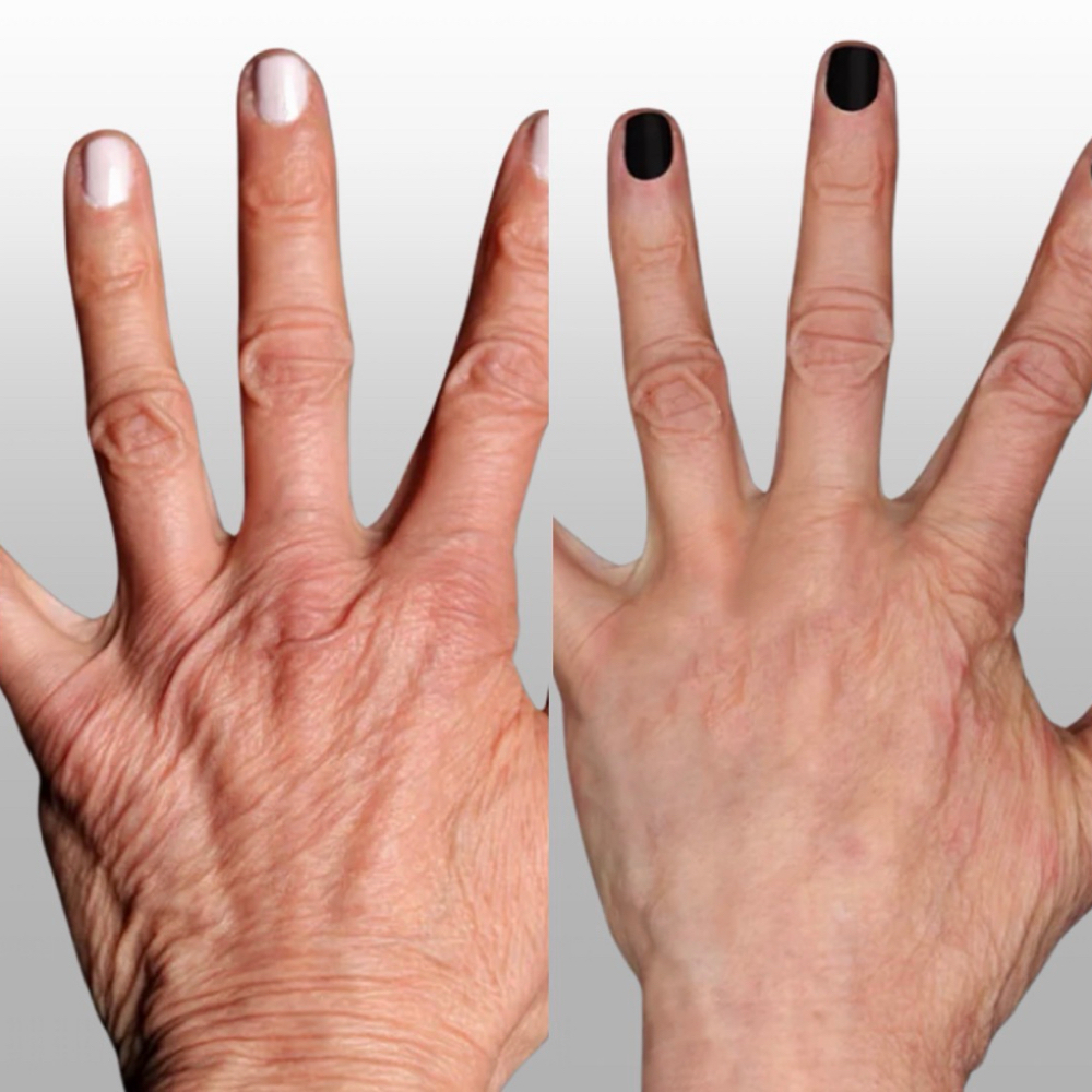 hand REJUVENATION (for crepey skin) at BEAUTY LAB COLLECTIVE in Miami, FL