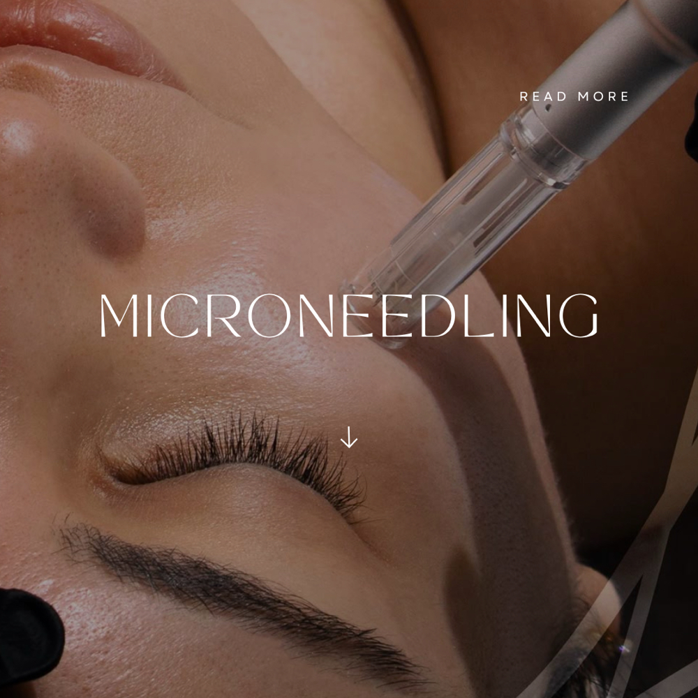 Microneedling Full Face & Neck at JessAnne Aesthetics in San Antonio, TX