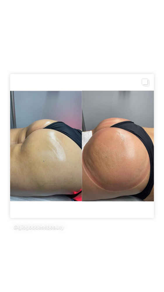 VBBL 🍑 (Vacuum Brazilian Buttlift)