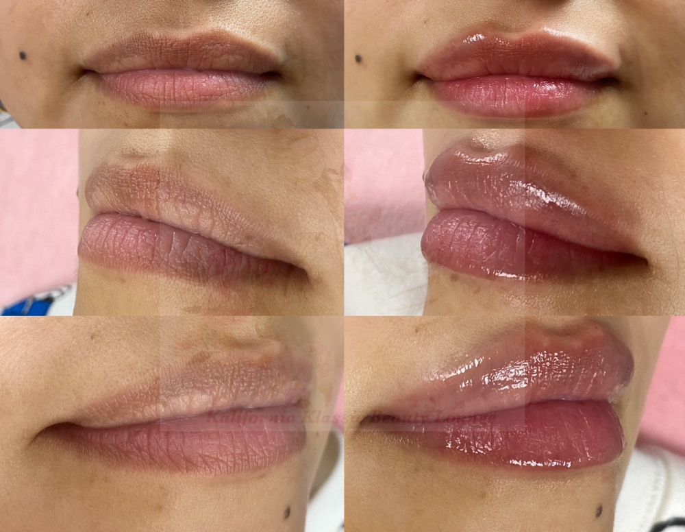Hya Platinum Touch Up Only