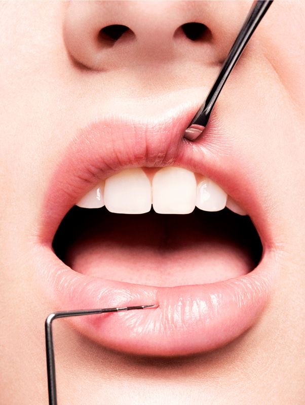 Composite Removal