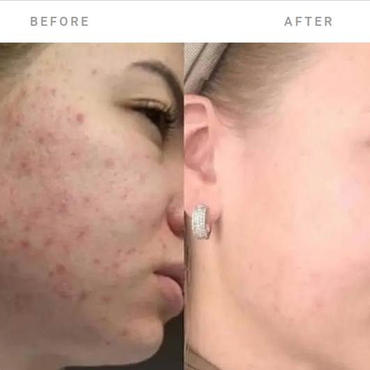 Chemical Peel GOLD at OH  BEAUTY  BAR in Bellingham, WA