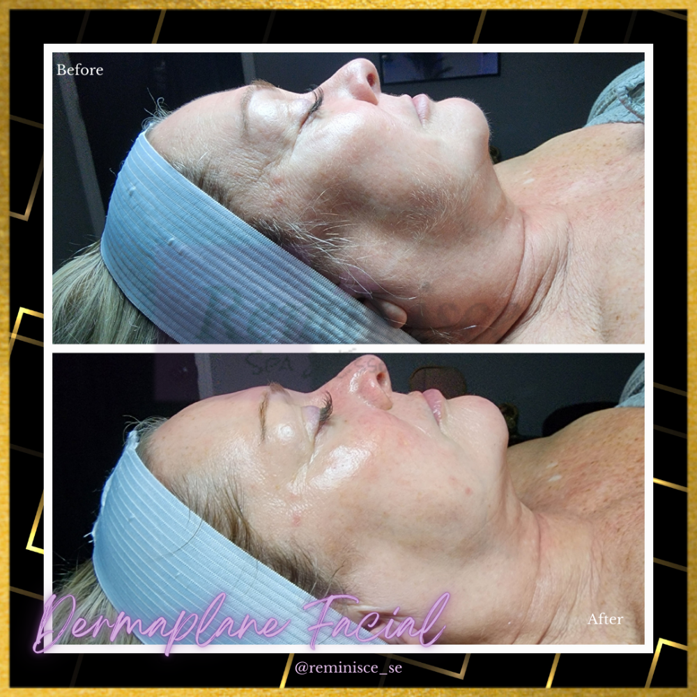 Dermaplane Facial (Most Booked)