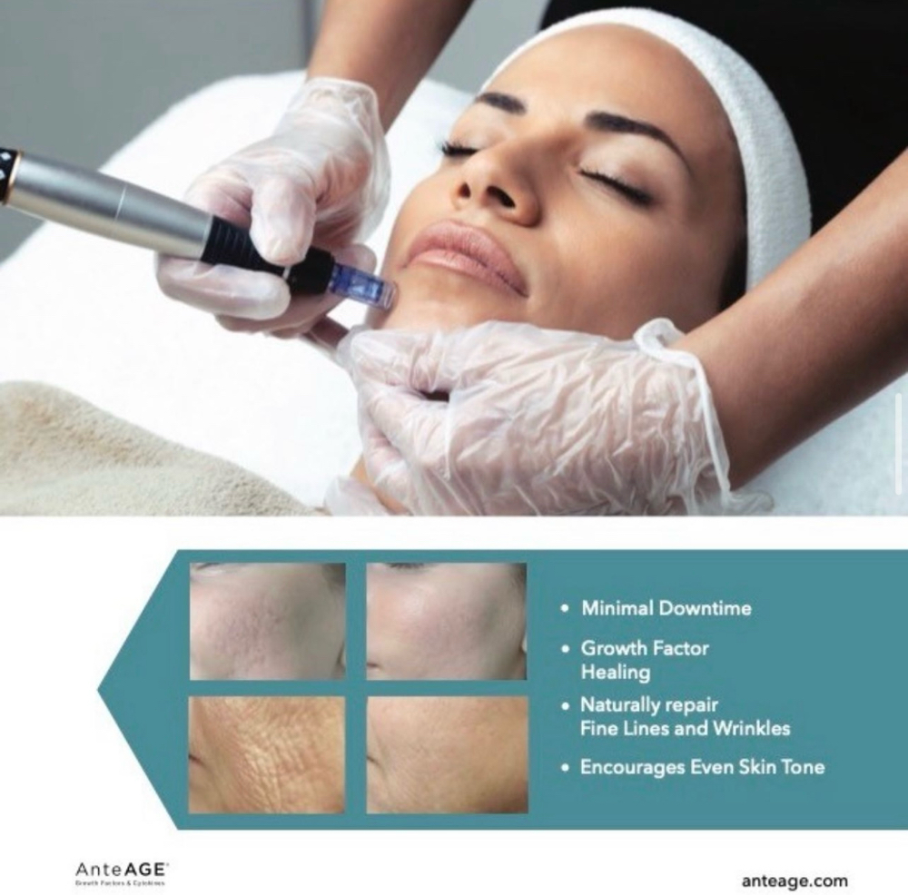 Medical Microneedling + Stem Cells