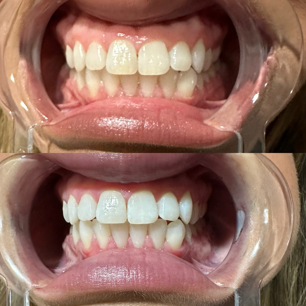 Teeth Whitening