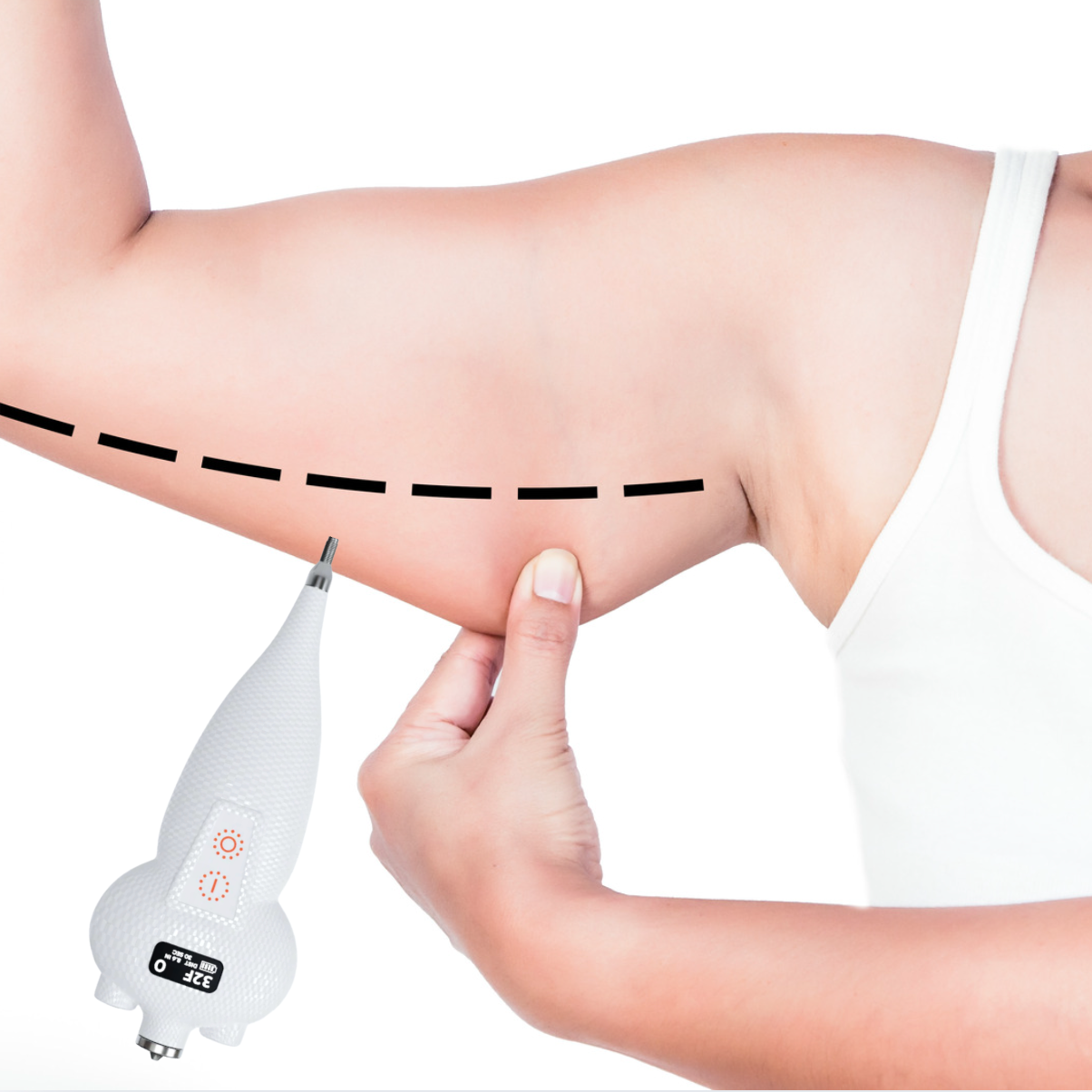 Targeted Cryo Batwings (Underarms) at Ultimate Solutions Medical Spa in Stamford, CT