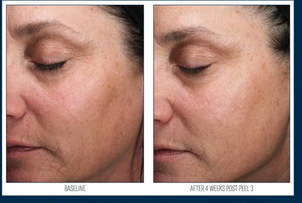 SkinBetterScience Alpharet Pro Peel