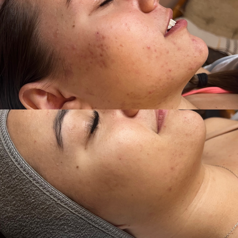 Microneedling