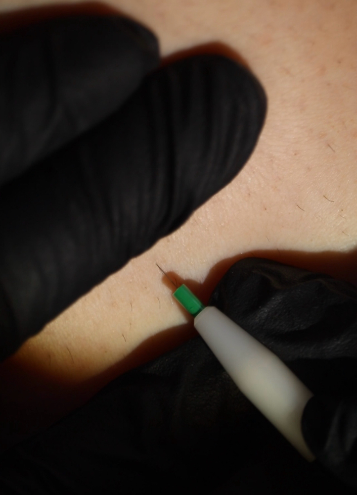 30-Minute Electrolysis Treatment