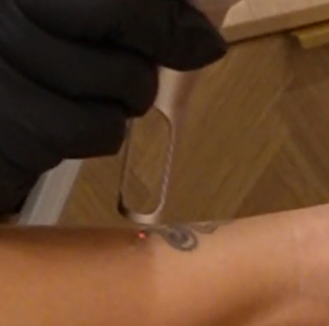 Laser Tattoo Removal