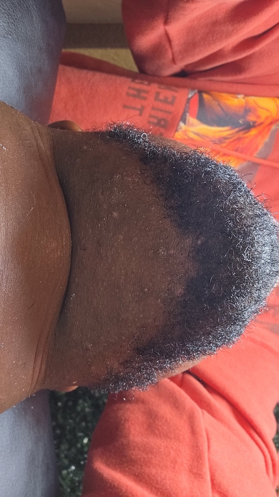 Ingrown Hair Treatment
