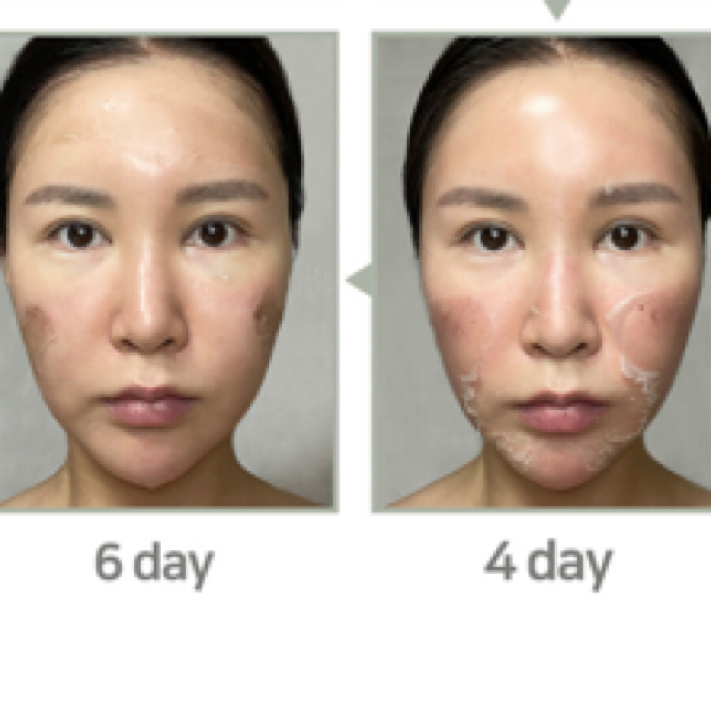 Chemical Peel at Nurse Ink/Rao Med Spa in Covington, LA
