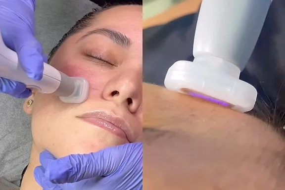 JET PLASMA Anti-Aging Treatment