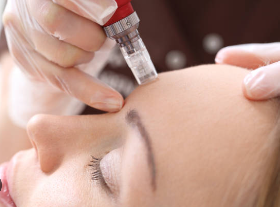 MicroNeedling