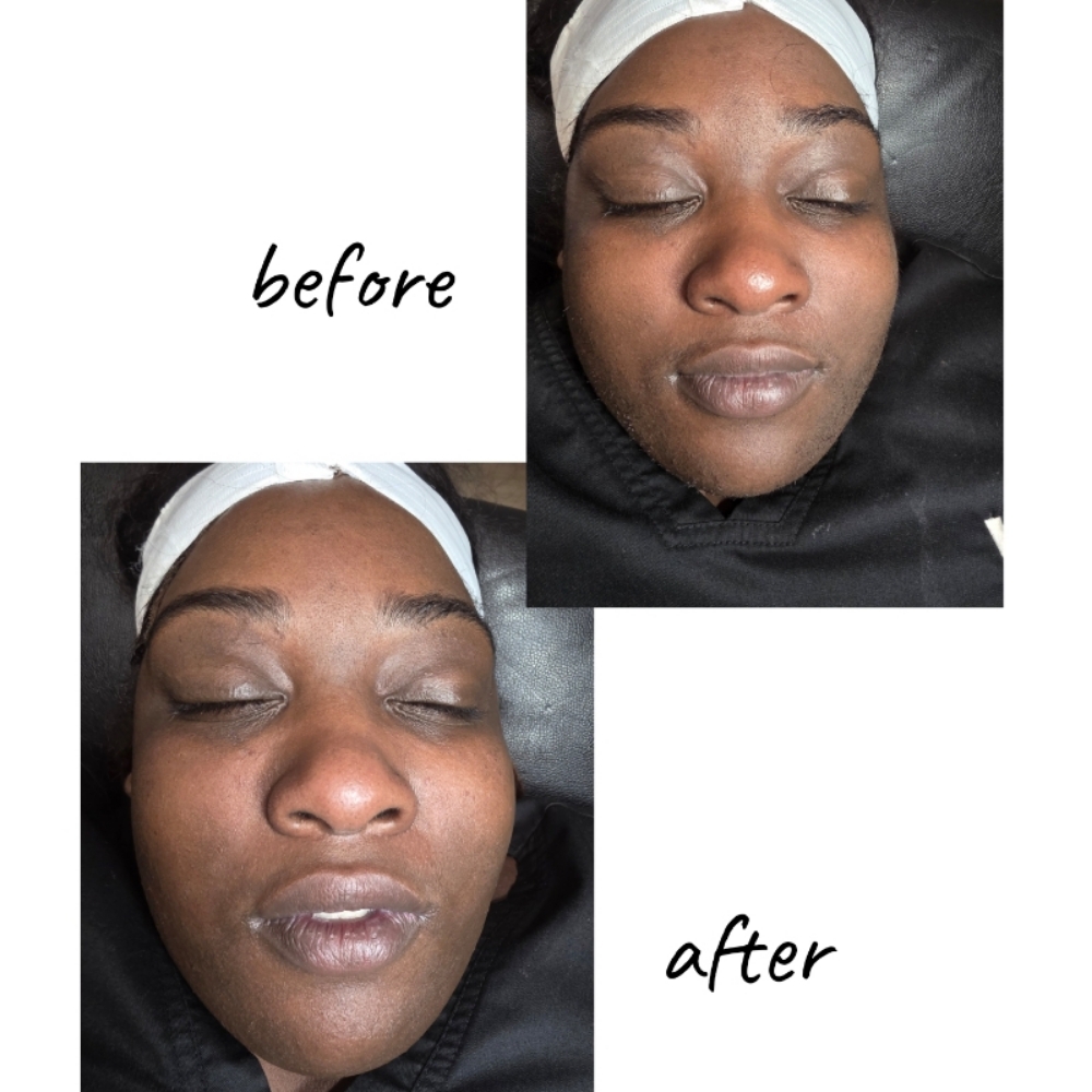Dermaplaning Facial at PURE ELEGANCE in Lubbock, TX