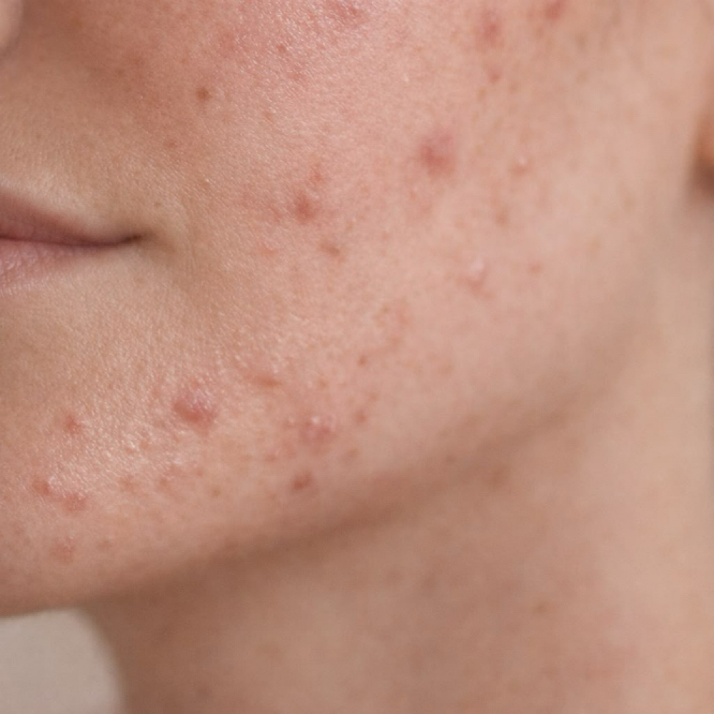 Acne Bootcamp Consultation at Beauty & Skin by Tristin in Russellville, KY