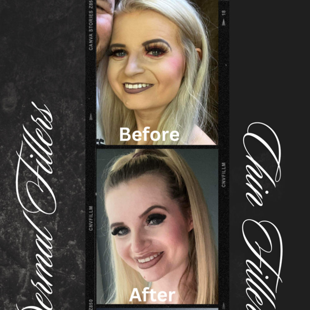 Chin Filler at Abigail Espinoza in Angleton, TX