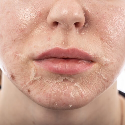 Chemical Peel at Twilla MedSpa in Fort Smith, AR