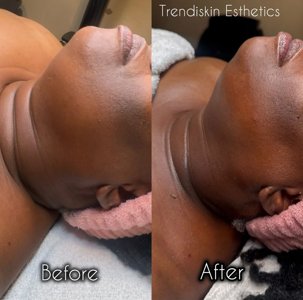 Anti-Aging Peptide Treatment