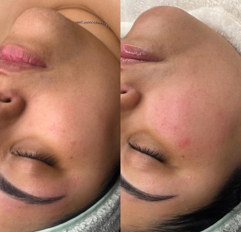Dermaplaing Facial