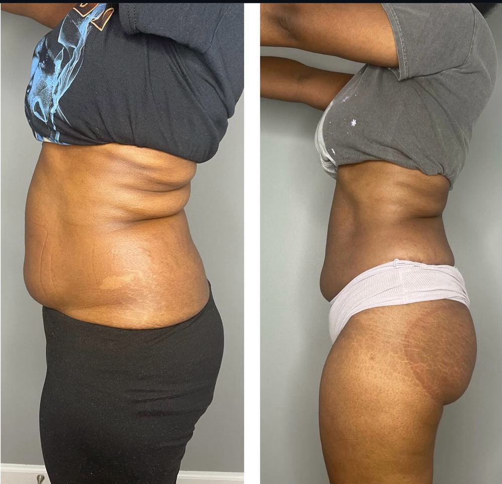 Body Sculpting Package Save 20%