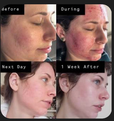 Dermaplanning & Micro-needling