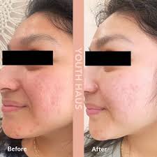 Microneedling with PRP