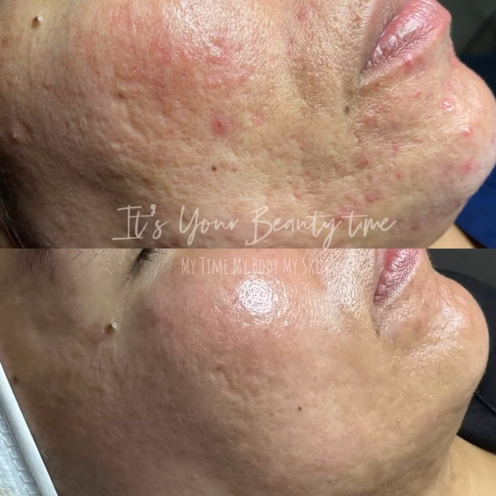 Microchanneling + LED at It’s Your Beauty Time in Downey, CA