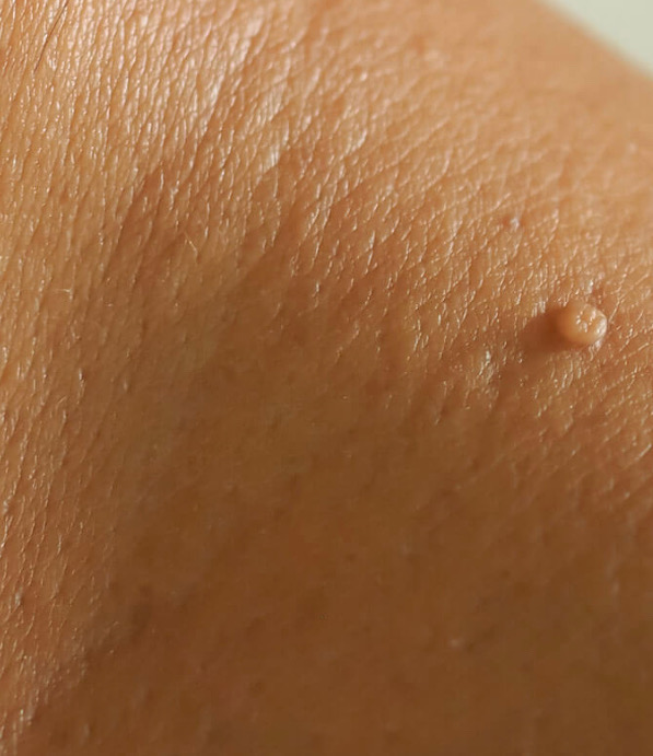 Skin Tag Removal