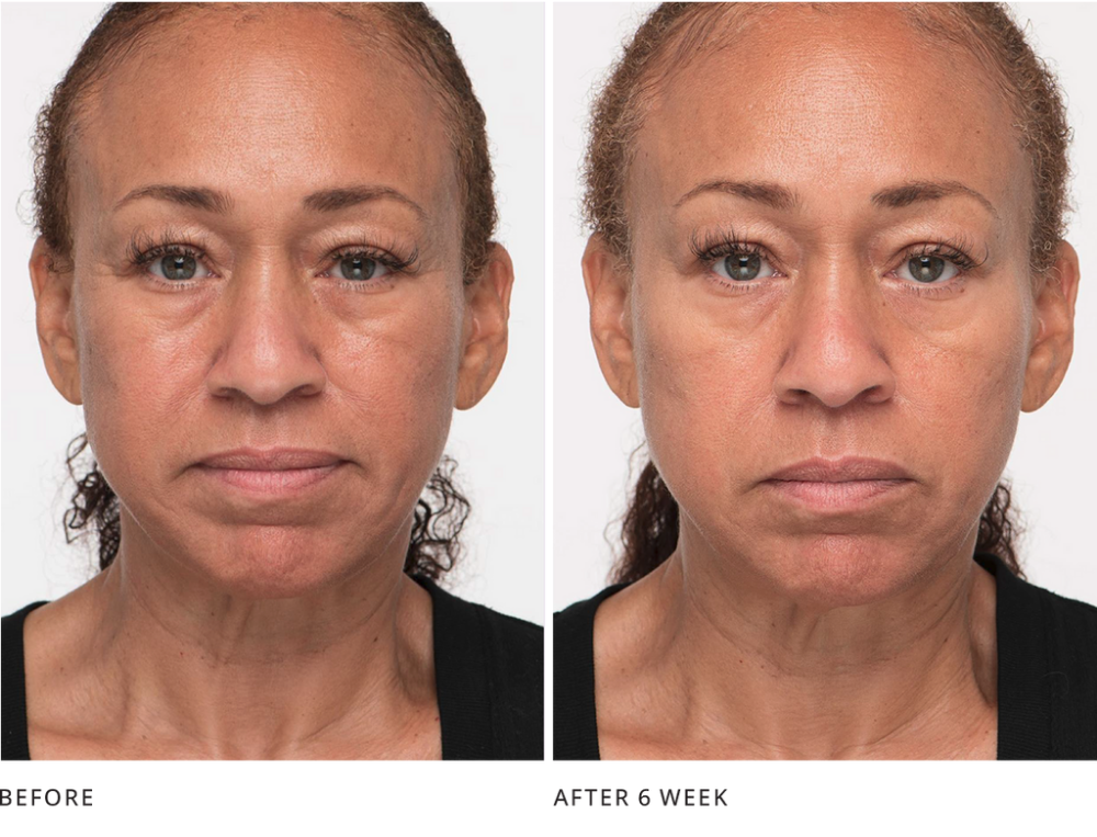 NonInvasive Facelift