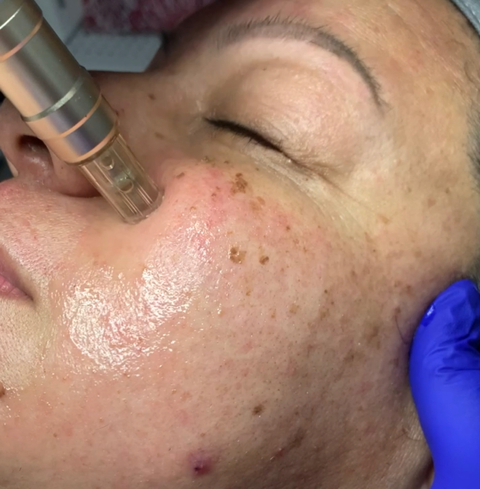 Microneedling