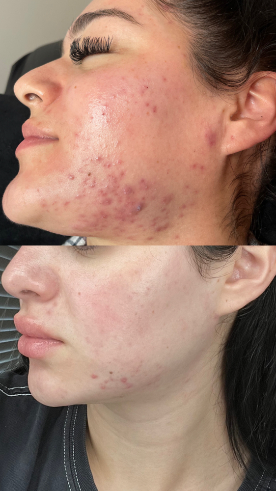 Purifying Acne Facial