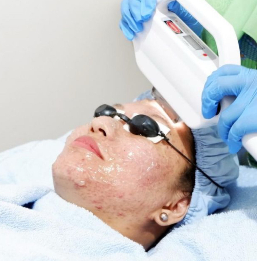 IPL Facial