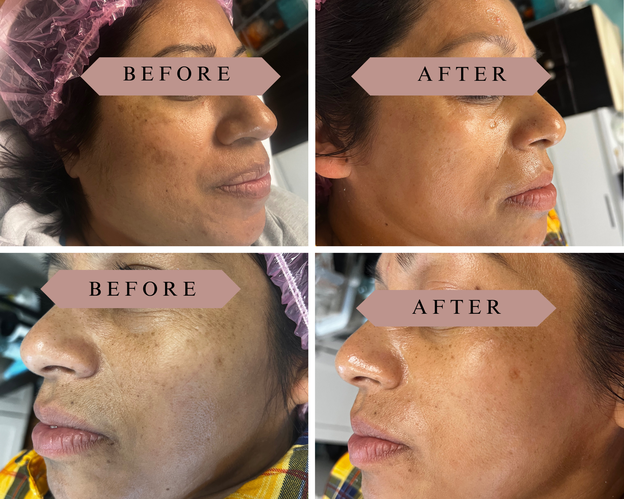 Facial Microdermabrasion