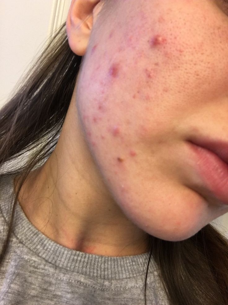 Acne Facial