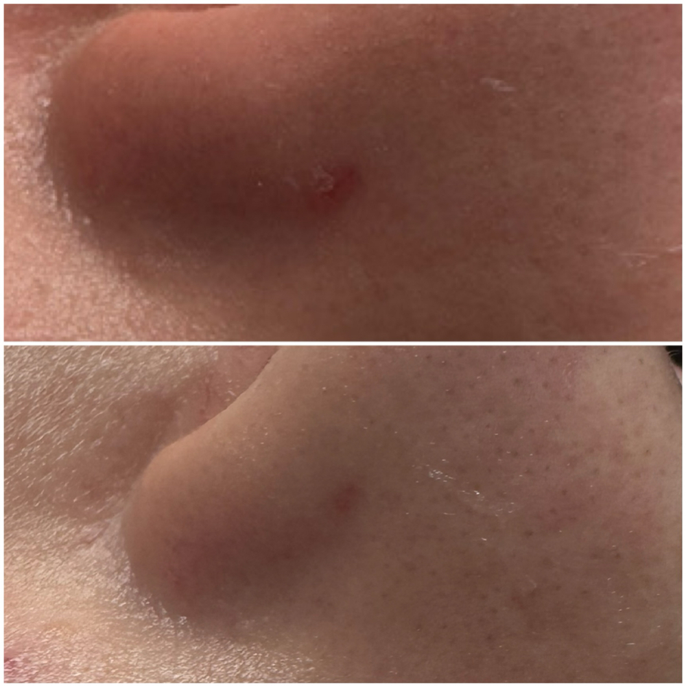 🎯 CO₂ Texture Refinement at Tru U Esthetix in Franklin, TN