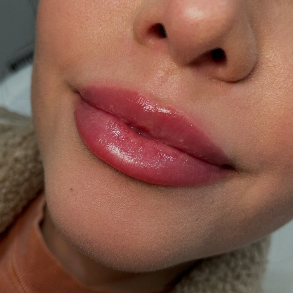 Lip Augmentation at THE BYOODE STUDIO in Lombard, IL