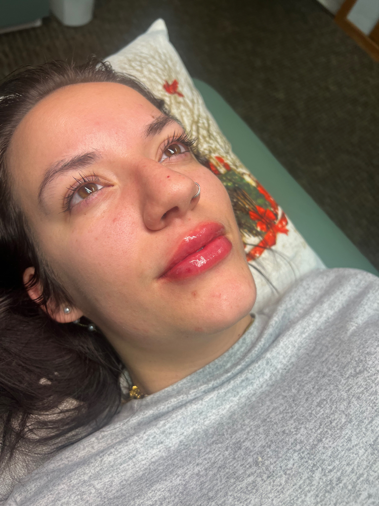 1ml Lip Plump
