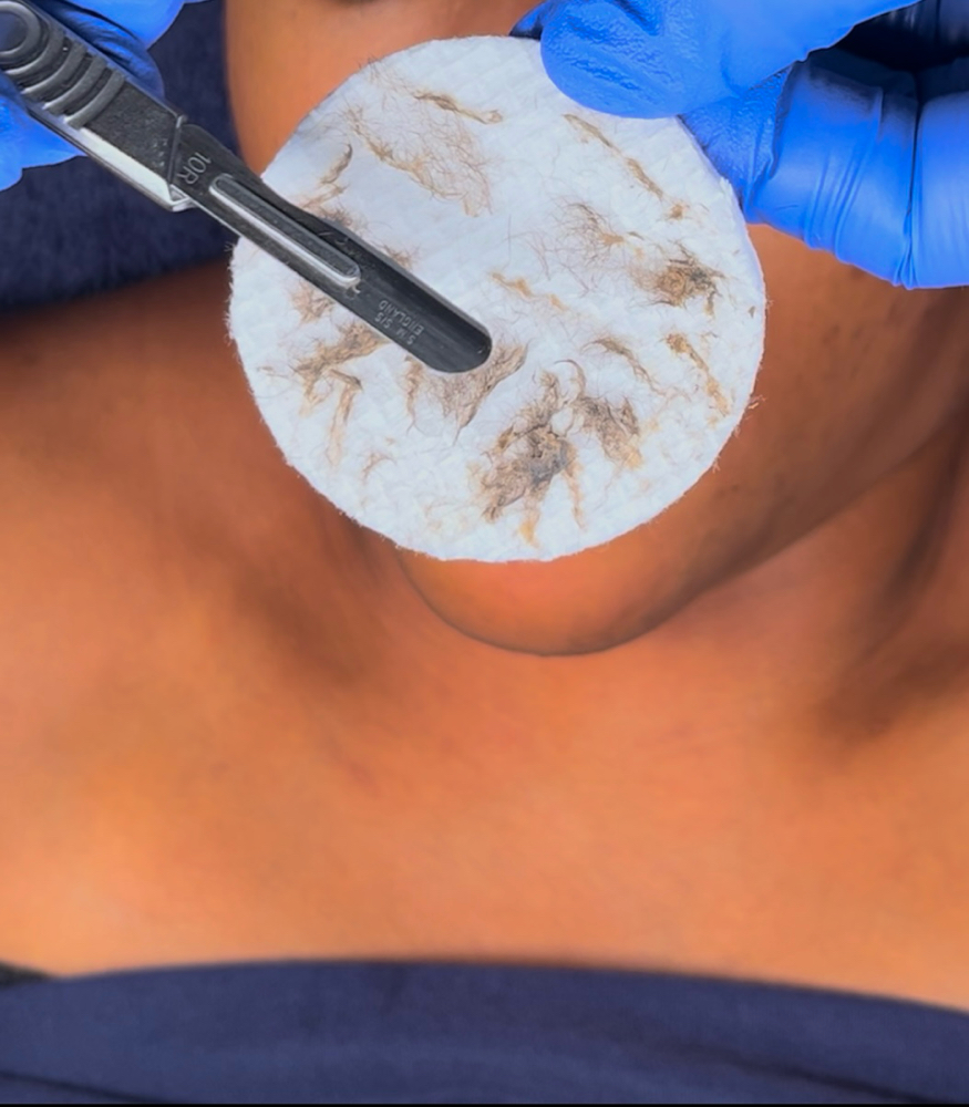 Dermaplaning Add On